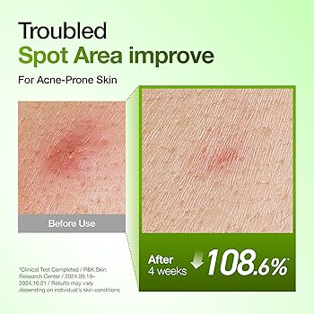 Anua Azelaic Acid 10 Hyaluron Redness Soothing Serum 30ml